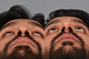 patient before and after rhinoplasty
