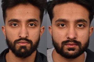 patient before and after rhinoplasty