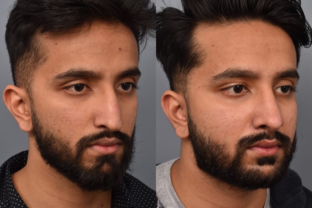 patient before and after rhinoplasty