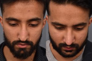 patient before and after rhinoplasty