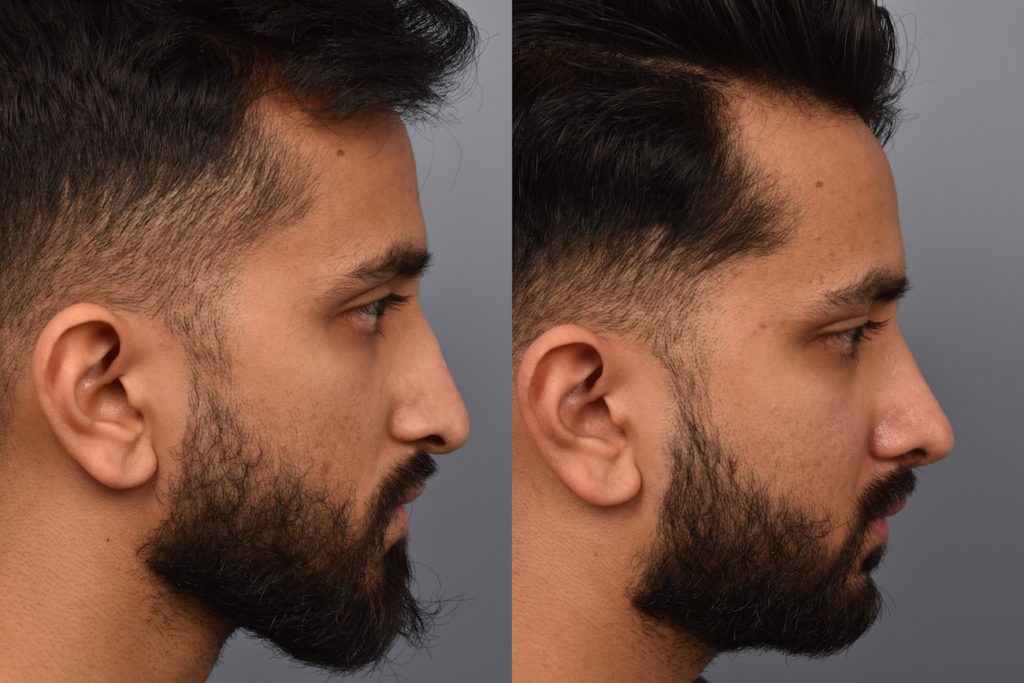 patient before and after rhinoplasty