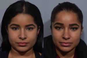 patient before and after revision rhinoplasty