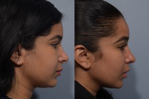 patient before and after revision rhinoplasty