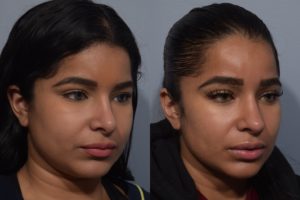 patient before and after revision rhinoplasty