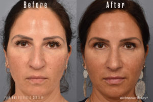 patient before and after rhinoplasty