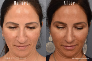 patient before and after rhinoplasty