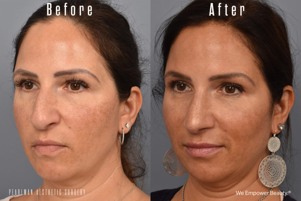patient before and after rhinoplasty