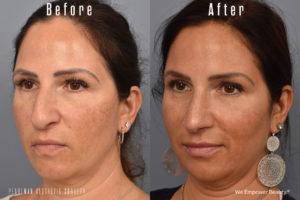 patient before and after rhinoplasty