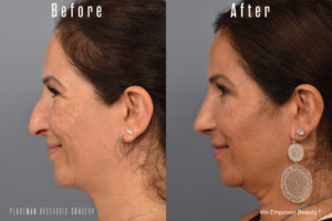 patient before and after rhinoplasty