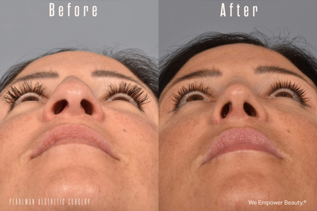 patient before and after rhinoplasty