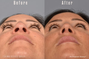 patient before and after rhinoplasty