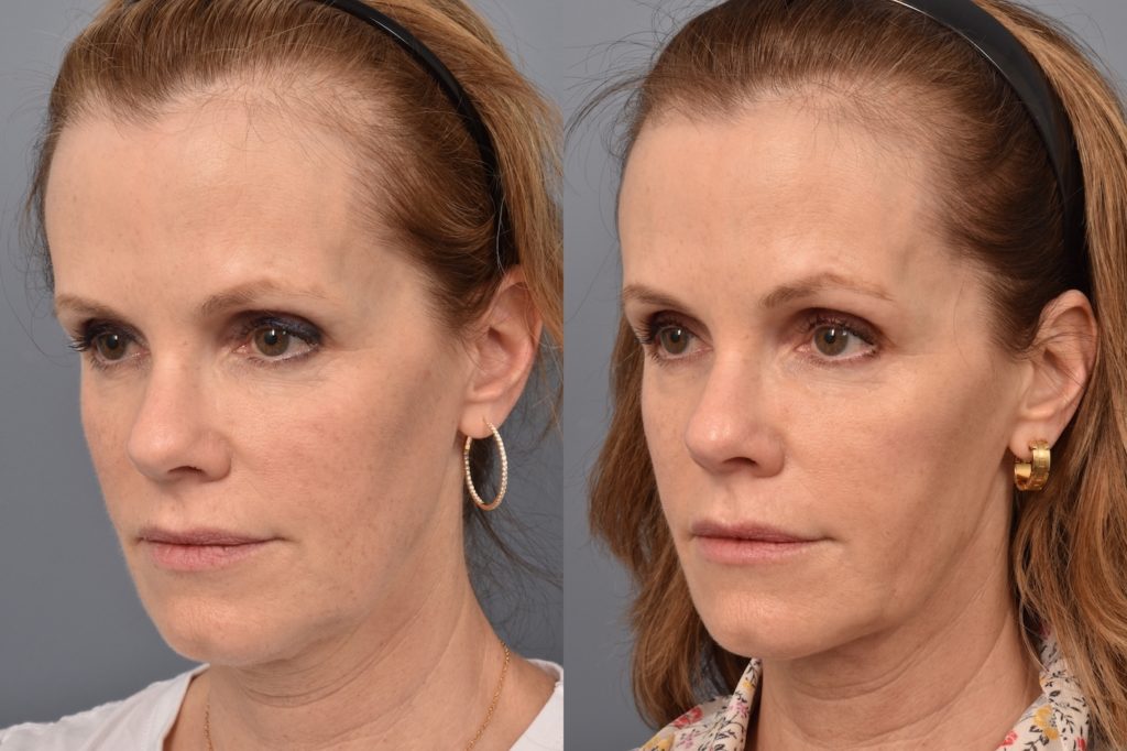 patient before and after FaceTite