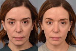 patient before and after FaceTite