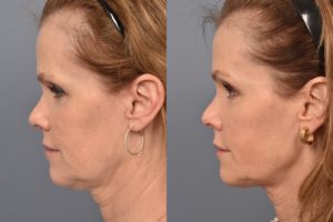 patient before and after FaceTite