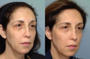 patient before and after FaceTite