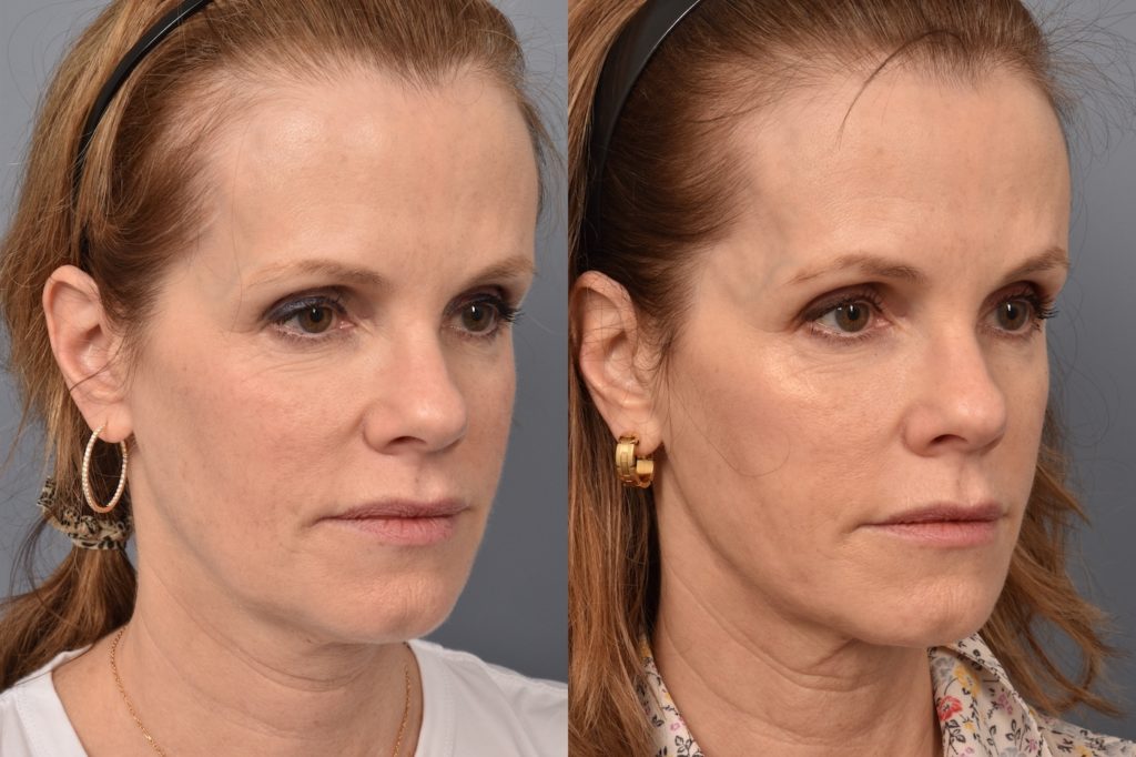 patient before and after FaceTite
