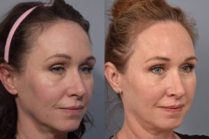 patient before and after FaceTite