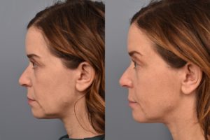 patient before and after FaceTite