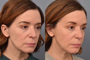 patient before and after FaceTite