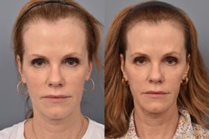 patient before and after FaceTite