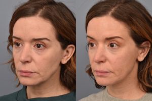 patient before and after FaceTite