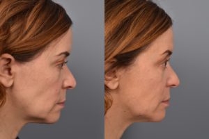 patient before and after FaceTite