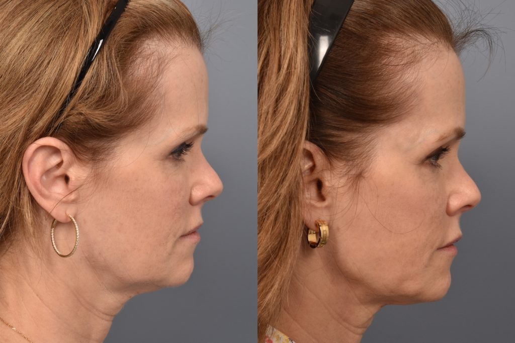 patient before and after FaceTite