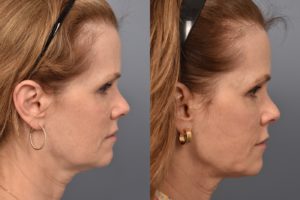 patient before and after FaceTite