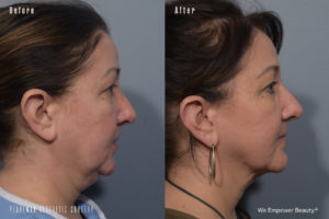 patient before and after FaceTite