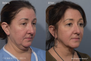 patient before and after FaceTite