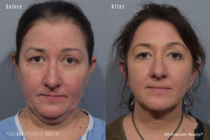 patient before and after FaceTite