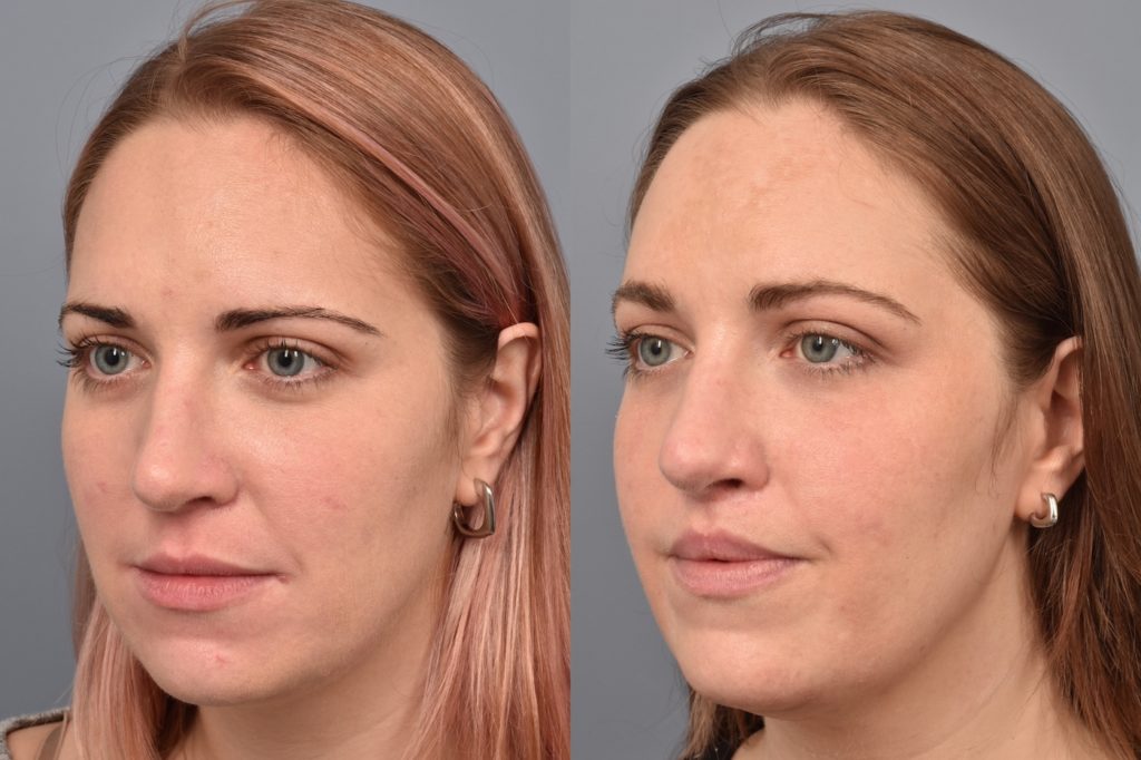 patient before and after lip lift