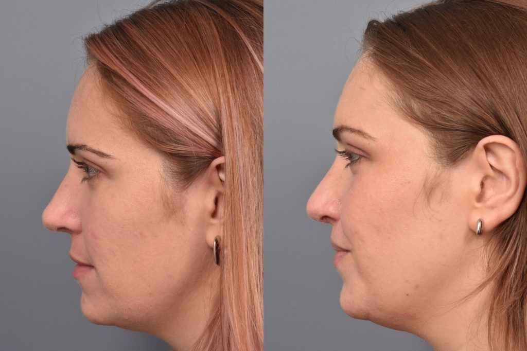 patient before and after lip lift