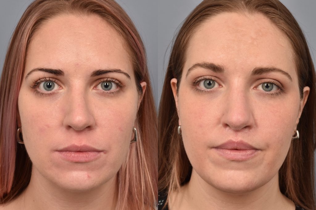 patient before and after lip lift