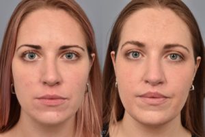 patient before and after lip lift