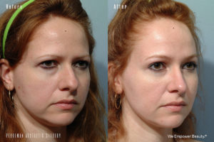 patient before and after eyelid surgery