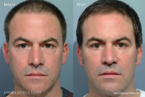 patient before and after eyelid surgery