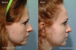 patient before and after eyelid surgery