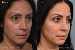 patient before and after eyelid surgery