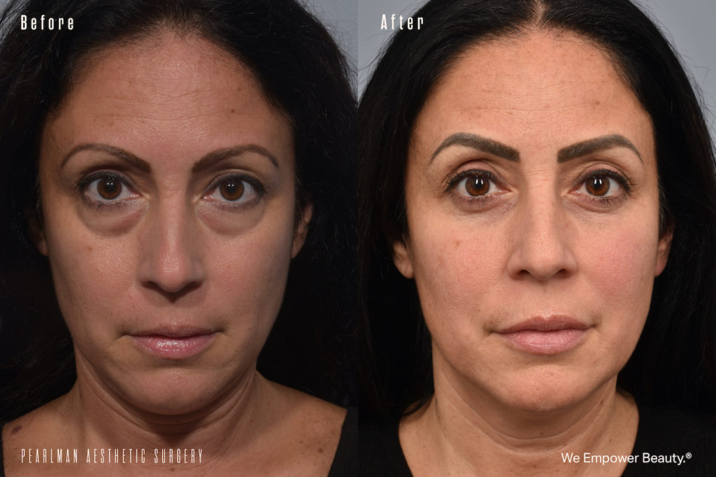patient before and after eyelid surgery