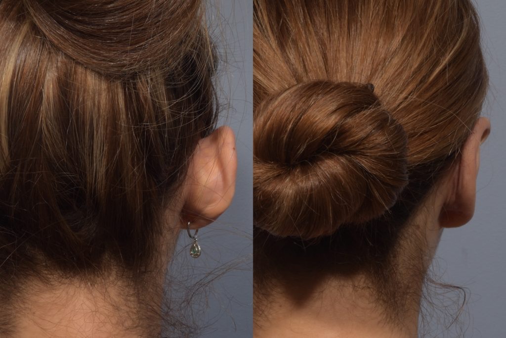 patient before and after otoplasty