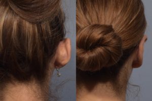 patient before and after otoplasty
