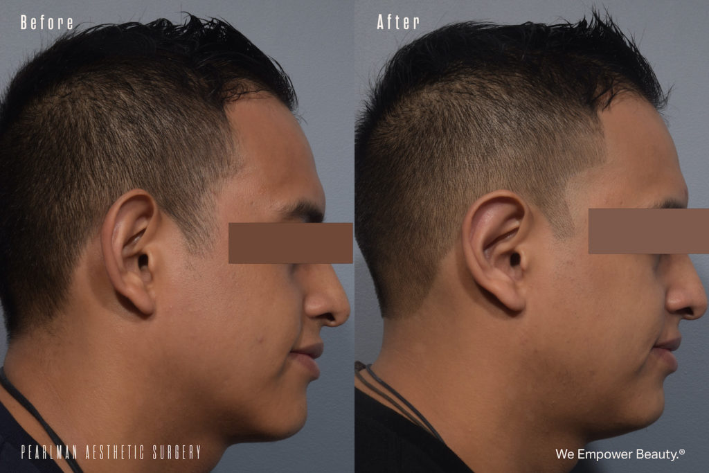 patient before and after otoplasty