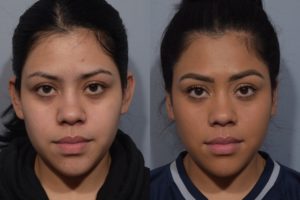 patient before and after otoplasty