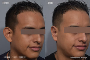 patient before and after otoplasty