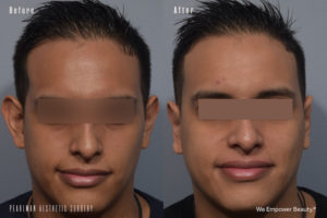 patient before and after otoplasty