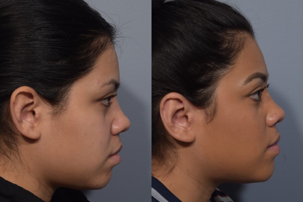 patient before and after otoplasty