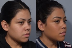 patient before and after otoplasty