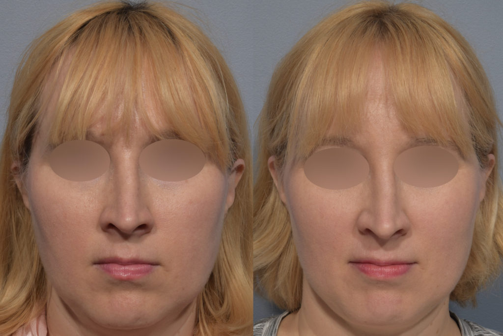 patient before and after neck lipo