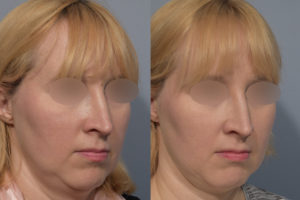 patient before and after neck lipo